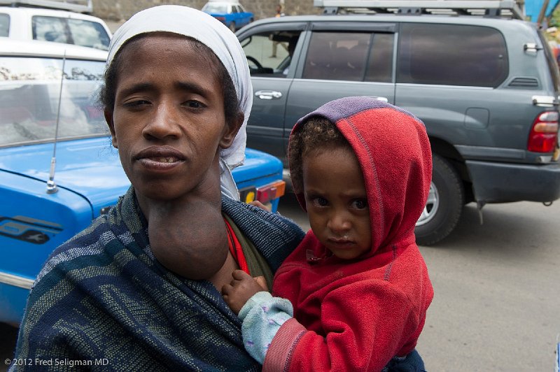 20120404_112401 Nikon D3S (6) 2x3.jpg - Horner's syndrome (drooping of the right eye)  is sometimes seen in cases of goitre (throid enlargement).  Lady was standing in the street as my vehicle was inching along in traffic on my way to the airport.  I gave this lady some money in return for the photo.  The incidence of goitre in Ethiopia is 25% and is highest in children.